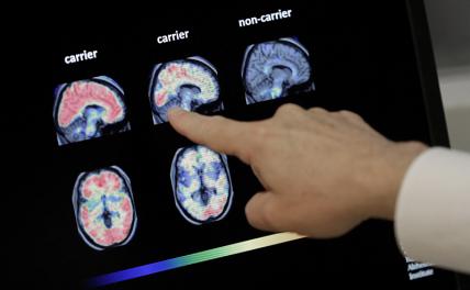 Альцгеймер, изыди! Китайцы нашли лекарство от главной болезни старости